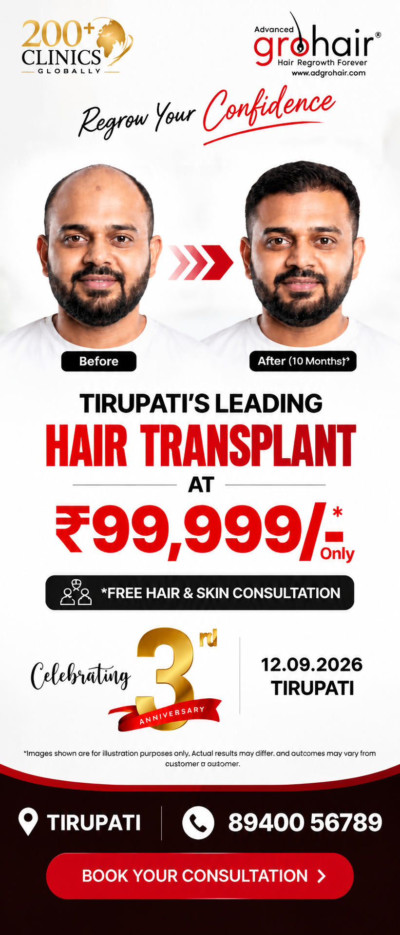 Adgrohair Tirupati hair transplant offer and consultation details