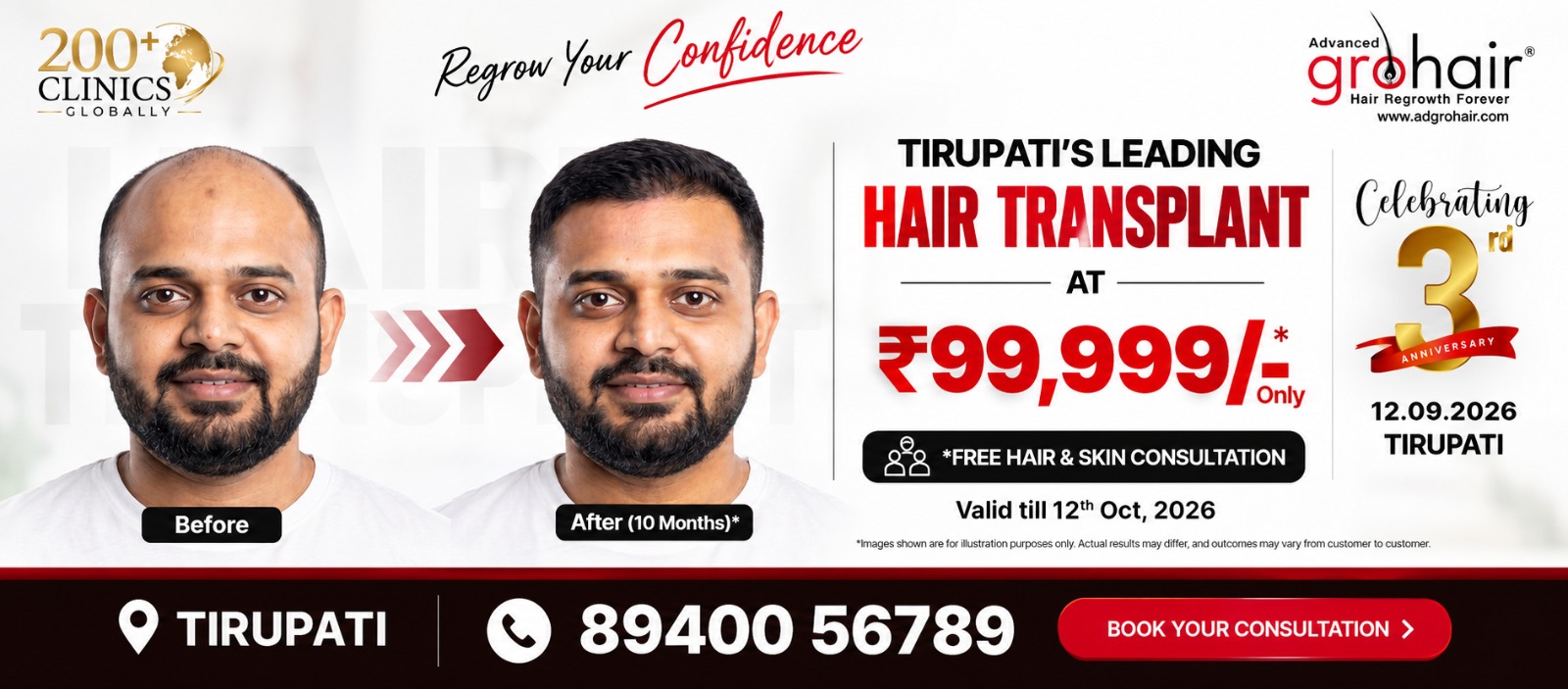 Adgrohair Tirupati hair transplant offer and consultation details