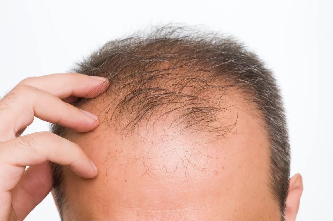 Genetic hair loss treatment progress