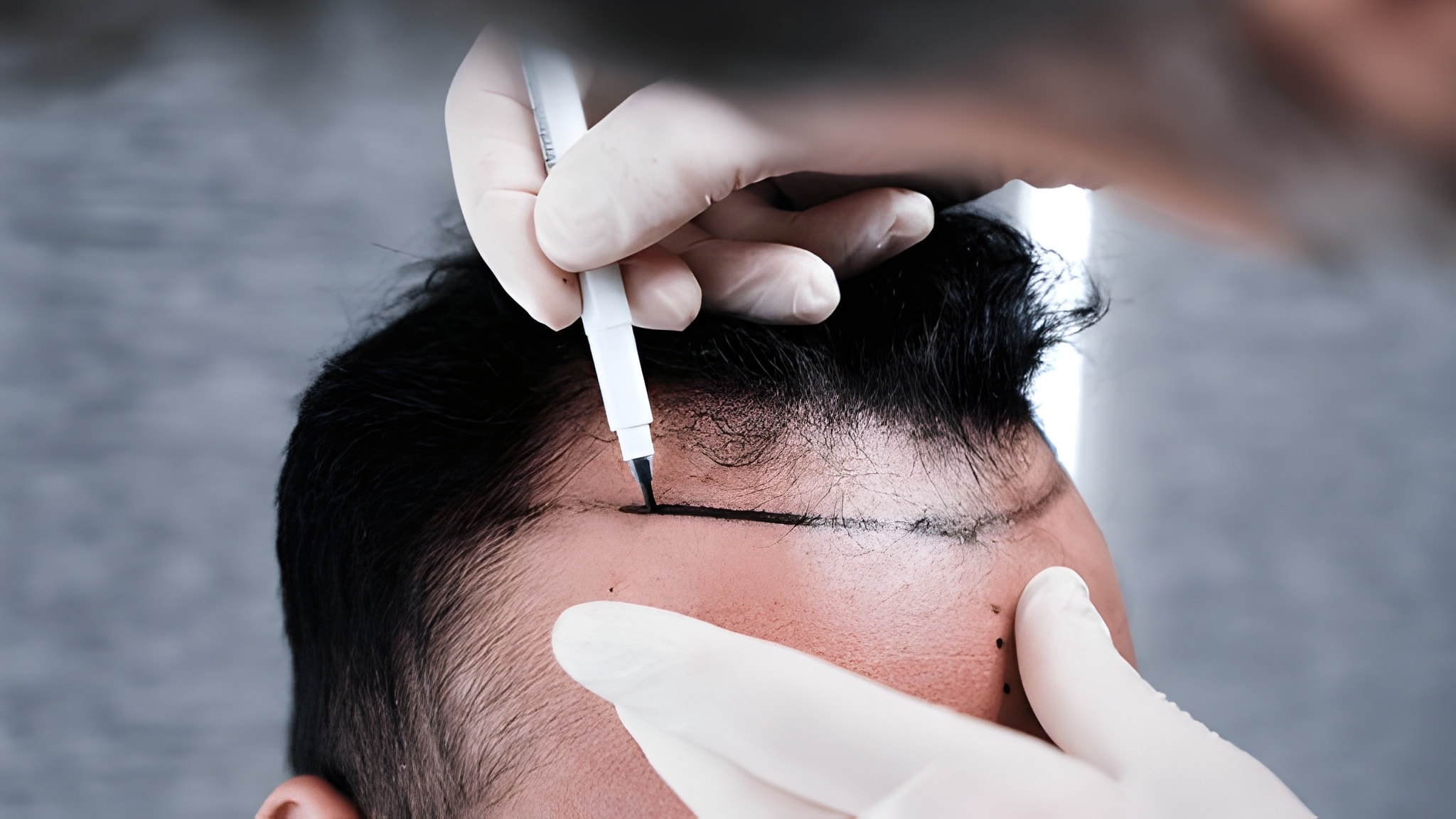 Advanced Grohair hair restoration results